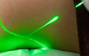 Laser – an effective treatment and an alternative solution for kidney removal…